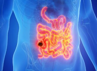 Percée en immunothérapie : un nouvel essai montre une rémission à long terme du cancer de l’intestin à haut risque